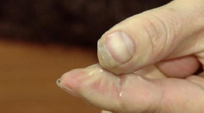 Quickly Remove 502 Glue from Skin – Here’s How