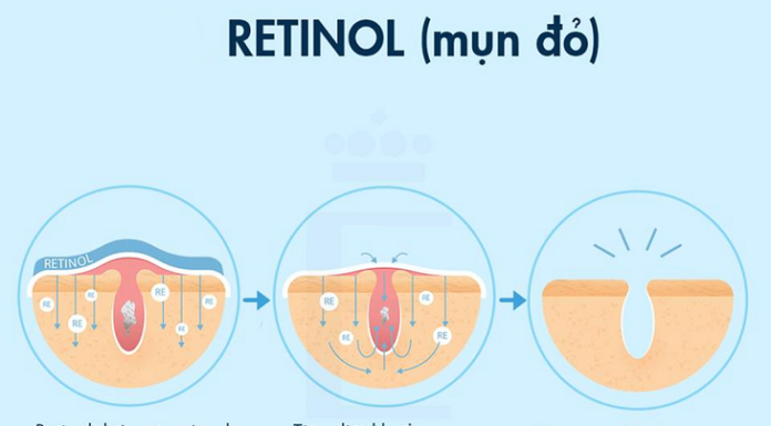 Retinol: A Fountain of Youth for Hair, Skin and Acne Prevention