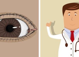 8 Easy and Effective Solutions for Skin Tag Removal in Women