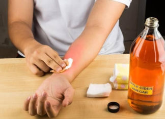 Quick and Safe Home Remedies for Treating Chili Burns