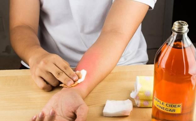 Quick and Safe Home Remedies for Treating Chili Burns