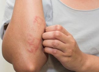 The Power to Heal: Unveiling Skin Allergies and Their Remedies