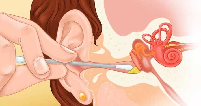 The Dangers of Cleaning Your Ears with Cotton Swabs