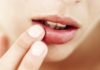 Treating Cracked and Chapped Lips in the Changing Seasons: How to Give Emergency Care