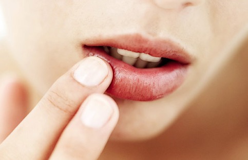 Treating Cracked and Chapped Lips in the Changing Seasons: How to Give Emergency Care