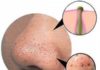 Get Rid of Blackheads with These Extremely Simple Methods