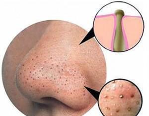 Get Rid of Blackheads with These Extremely Simple Methods
