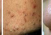 The 5 Most Common Types of Acne and Effective Treatment Methods You Should Know