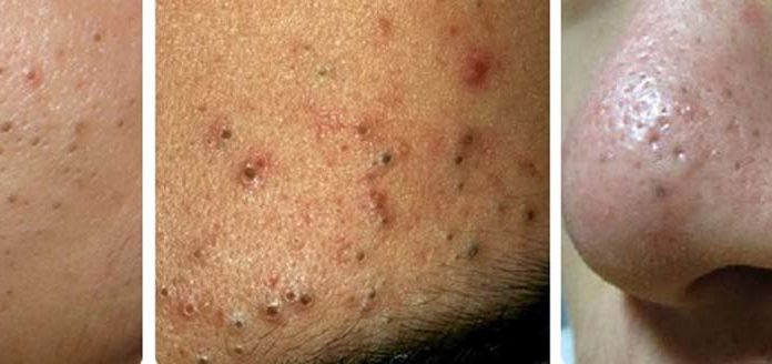 The 5 Most Common Types of Acne and Effective Treatment Methods You Should Know
