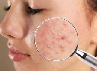 If you don’t change these 3 habits, hidden acne will worsen and your skin will deteriorate day by day
