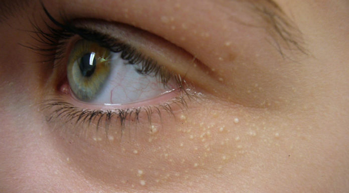 Effective strategies to deal with stubborn acne, leaving women regret-free