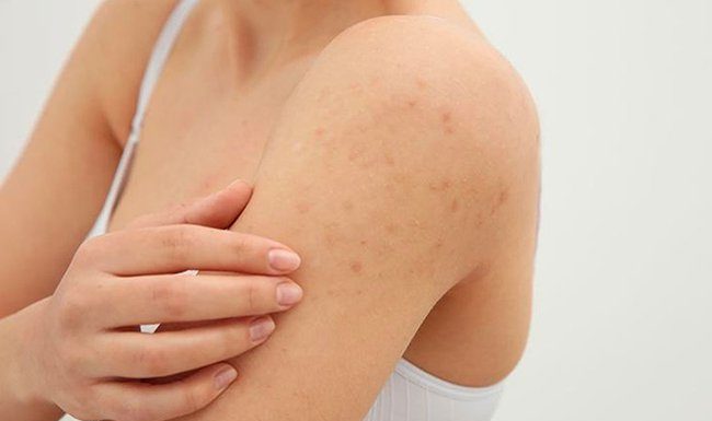 Unveiling some ways to exfoliate dead skin and reduce thickened horny follicles every time winter comes