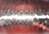 What is lingual braces? Advantages and disadvantages of lingual braces