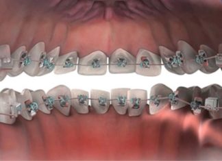 What is lingual braces? Advantages and disadvantages of lingual braces