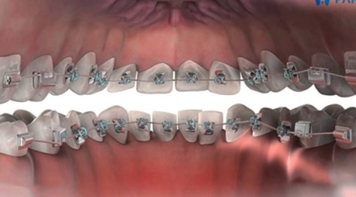 What is lingual braces? Advantages and disadvantages of lingual braces