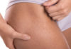 5 Simple Ways to Treat Stretch Marks at Home