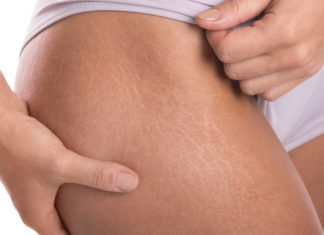 5 Simple Ways to Treat Stretch Marks at Home
