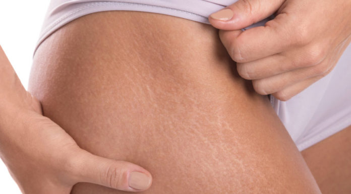 5 Simple Ways to Treat Stretch Marks at Home