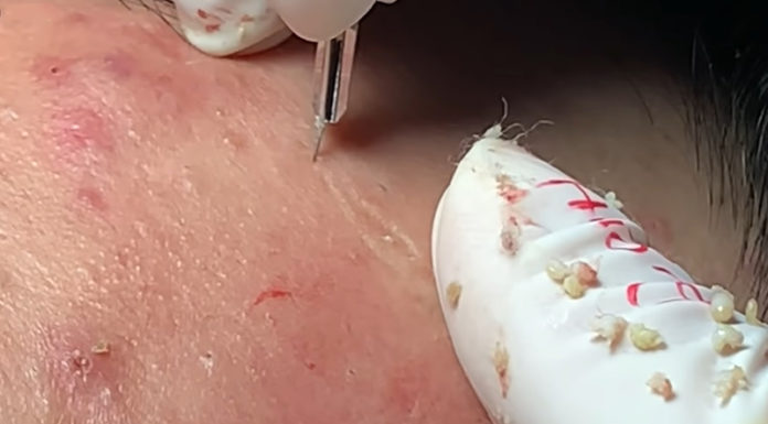 The Ultimate ASMR Pimple-Popping Extravaganza: A Satisfying and Sensory Journey.