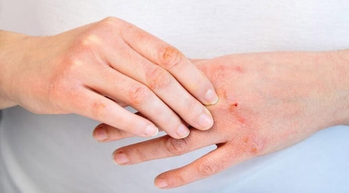 Pocket the basic skincare tips when dealing with sensitive skin