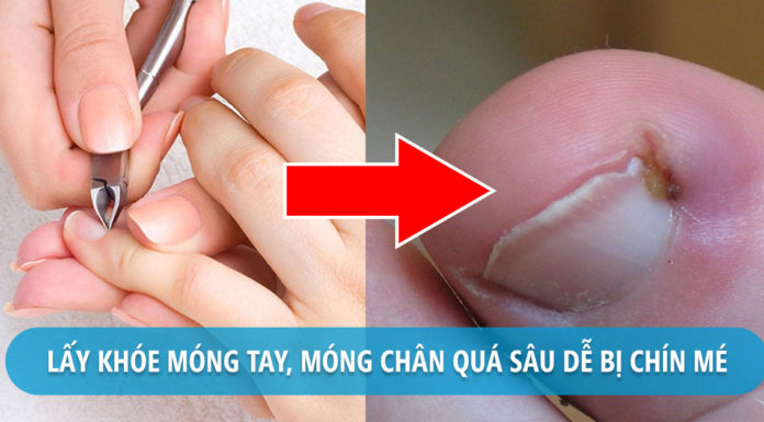 How to Treat Athlete’s Foot?