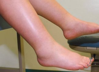 3 Signs on the Skin that Warn of Heart Disease: Cold Weather Demands Attention