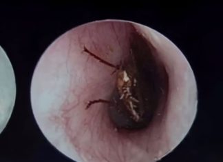 Clever Mother Removes Bug from Child’s Ear, Doctor Applauds Her Quick Thinking