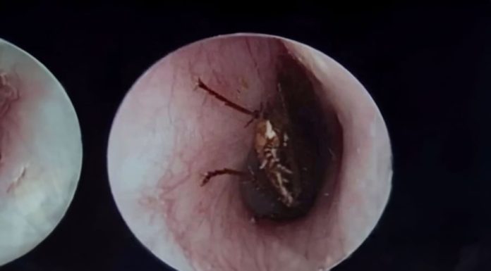 Clever Mother Removes Bug from Child’s Ear, Doctor Applauds Her Quick Thinking