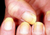 Signs of Nails: An Indication of Underlying Health Issues