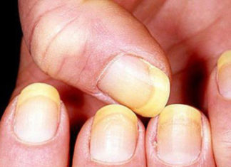 Signs of Nails: An Indication of Underlying Health Issues