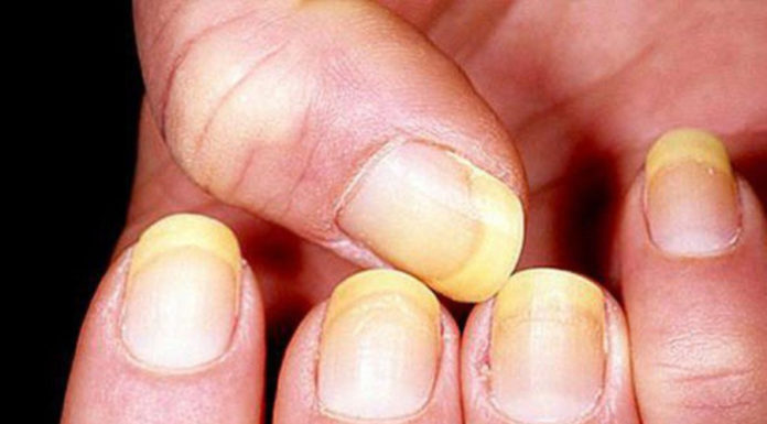 Signs of Nails: An Indication of Underlying Health Issues