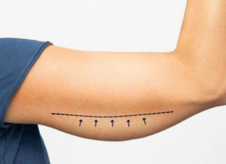 How to Manage Weight Loss and Loose Skin?