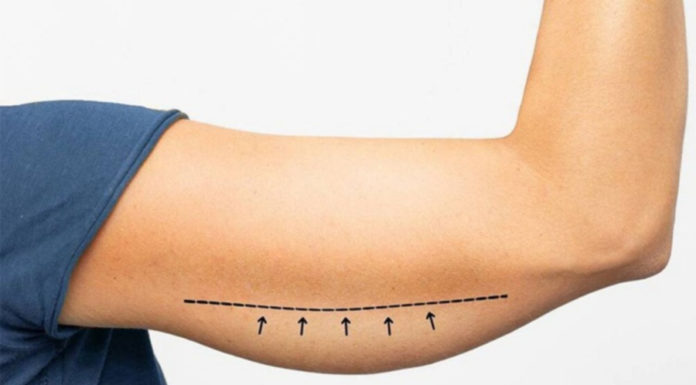 How to Manage Weight Loss and Loose Skin?