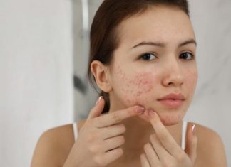 Tips to get rid of acne at home, prevent acne recurrence