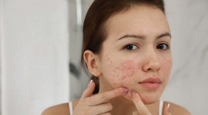Tips to get rid of acne at home, prevent acne recurrence