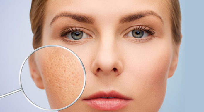Don’t let large pores bother you anymore, apply these 5 tips right away to help tighten your pores quickly in just a few minutes.