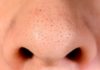 4 Safe and Non-Irritating Blackhead Removal Formulas