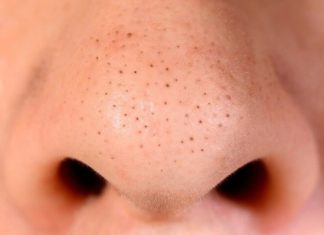 4 Safe and Non-Irritating Blackhead Removal Formulas
