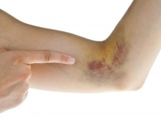 Effective tips to quickly fade bruise marks on the skin