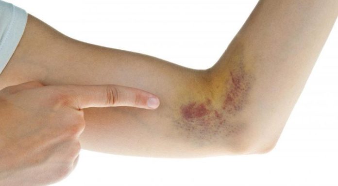 Effective tips to quickly fade bruise marks on the skin