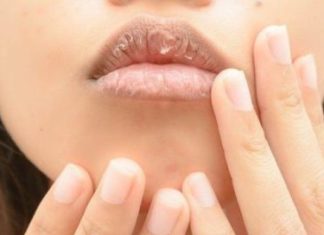 Tips for dealing with dry and cracked lips in the winter, alleviating discomfort for women