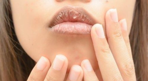 Tips for dealing with dry and cracked lips in the winter, alleviating discomfort for women