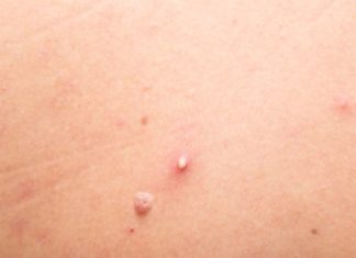 Effective and Quick Tips for Treating Whiteheads Effectively