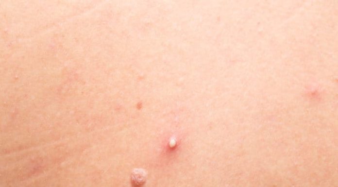 Effective and Quick Tips for Treating Whiteheads Effectively