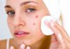 Basic tips for caring for acne-prone skin during winter