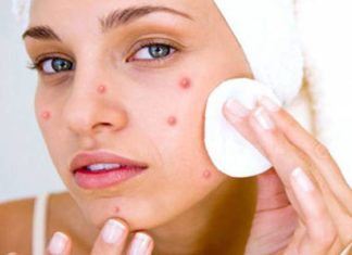 Basic tips for caring for acne-prone skin during winter
