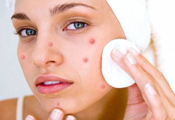 Basic tips for caring for acne-prone skin during winter