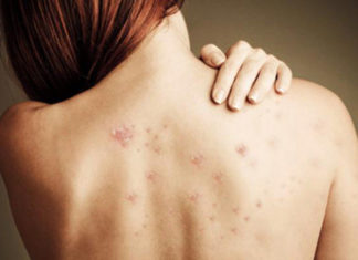 2 Common Mistakes That Cause Acne-Prone Skin and Stubborn Dark Spots