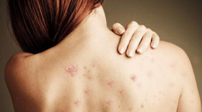 2 Common Mistakes That Cause Acne-Prone Skin and Stubborn Dark Spots