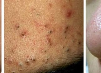 5 Most Common Types of Acne and Effective Treatment Methods to Know